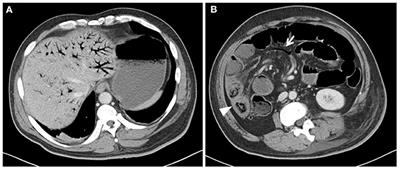 Case Report: A Rare Condition of Abdominal Pain: Chemotherapy Induced Portal Vein Pneumatosis Mimicking the Bowel Necrosis